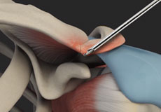 AC Joint Stabilization