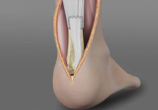 Achilles Tendon Repair