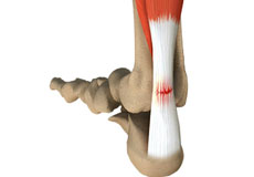 Achilles Tendon Rupture