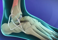 Ankle Ligament Reconstruction