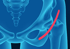 Anterior Hip Replacement