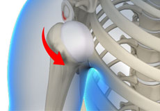 Anterior Shoulder Instability