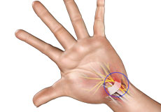 Carpal Tunnel Syndrome