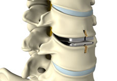 Cervical Arthroplasty