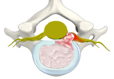 Cervical Herniated Disc