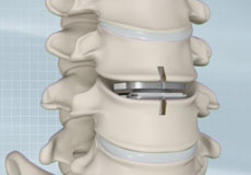 Cervical Disc Replacement