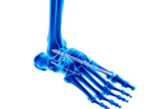 Charcot Foot Reconstruction