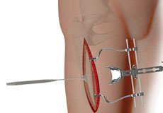 Complex Hip Reconstruction Surgery