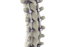 Complex Spinal Surgery