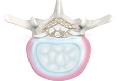 Degenerative Spine Surgery