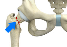 Femoral Neck Fracture