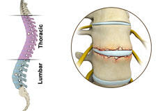 Fracture of the Thoracic and Lumbar Spine