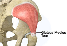 Gluteus Medius Tear