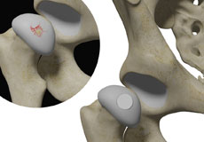 Hip Cartilage Restoration