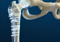 Hip Fracture Surgery