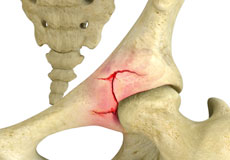 Hip Fracture