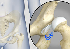 Hip Instability