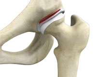 Hip Labral Tear