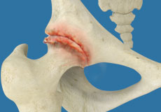 Osteoarthritis