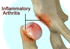 Inflammatory Arthritis of the Hip