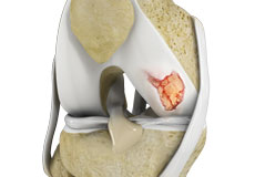 Knee Cartilage Restoration