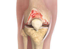 Knee Osteoarthritis