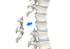 Laminectomy