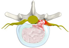 Herniated Disc (Lumbar)