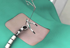 Minimally Invasive Spine Surgery for Spondylolisthesis
