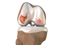 Osteoarthritis Management