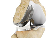 Partial Lateral Knee Replacement