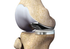 Partial Medial Knee Replacement