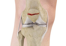 Fractures of the Patella