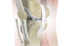 Patellar Tendon Repair