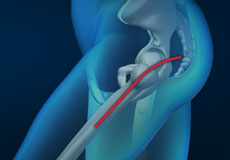 Posterior Hip Replacement