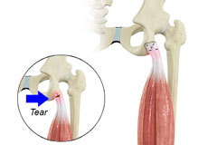 Proximal Hamstring Repair