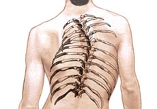 Scoliosis