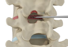 Spinal Decompression