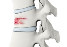 Spinal Fractures