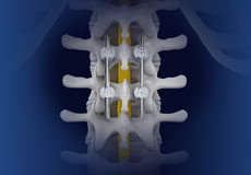 Spinal Fusion