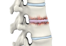 Spine Arthritis