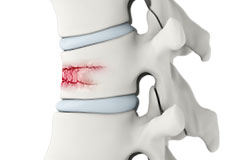 Spinal Compression Fractures