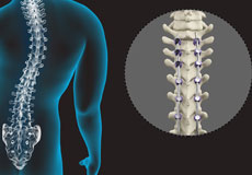 Spine Deformity Surgery