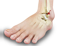 Stress Fractures of Foot and Ankle