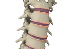 Surgical Treatment for Spine Conditions