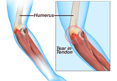 Tennis ElbowTennis Elbow