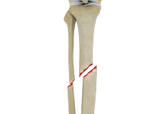 Tibial Shaft Fracture