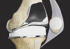 Tricompartmental Knee Replacement