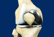 Unicondylar knee Replacement